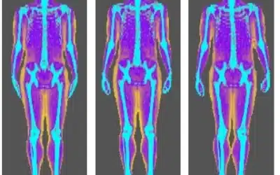 DEXA Toronto Scan Results