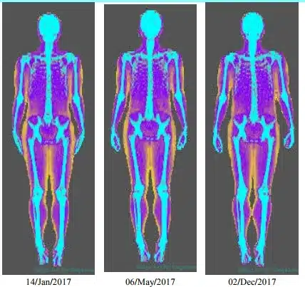 DEXA Toronto Scan Results